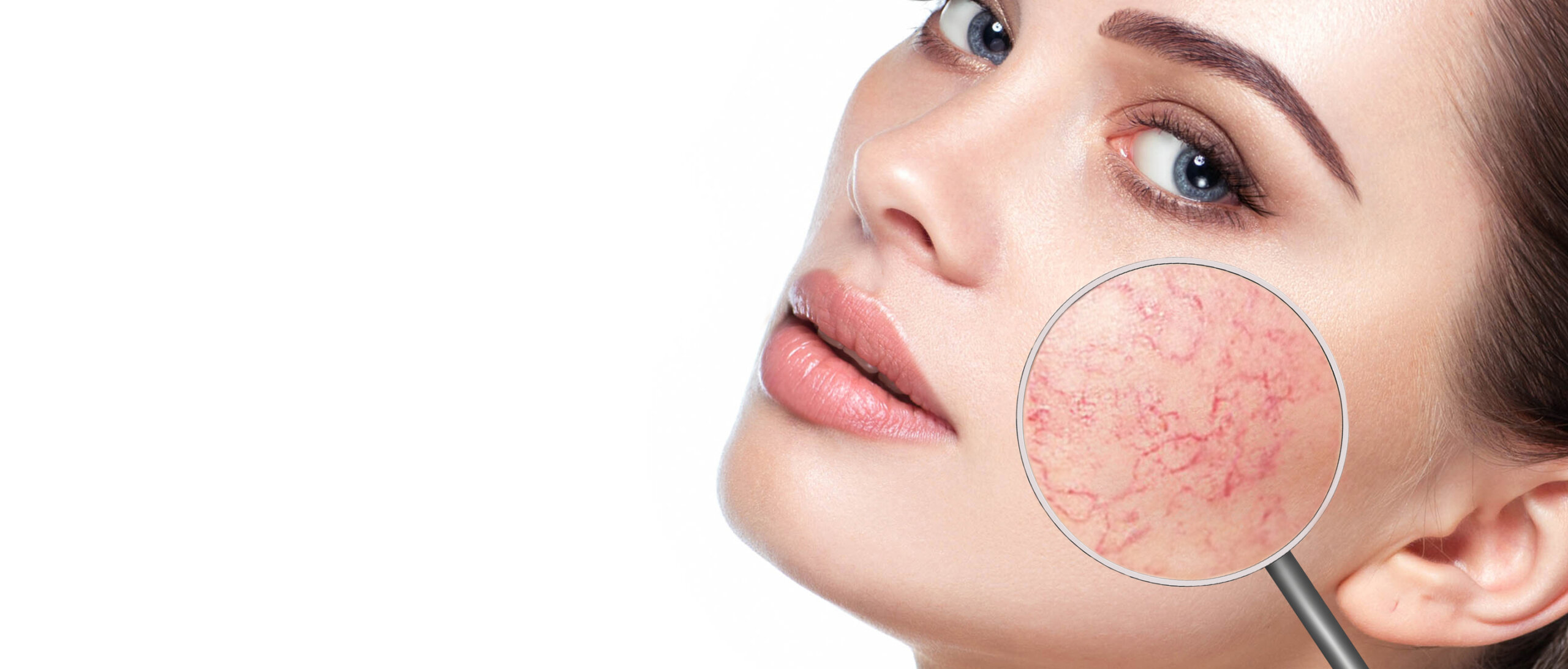 Rosacea and Redness