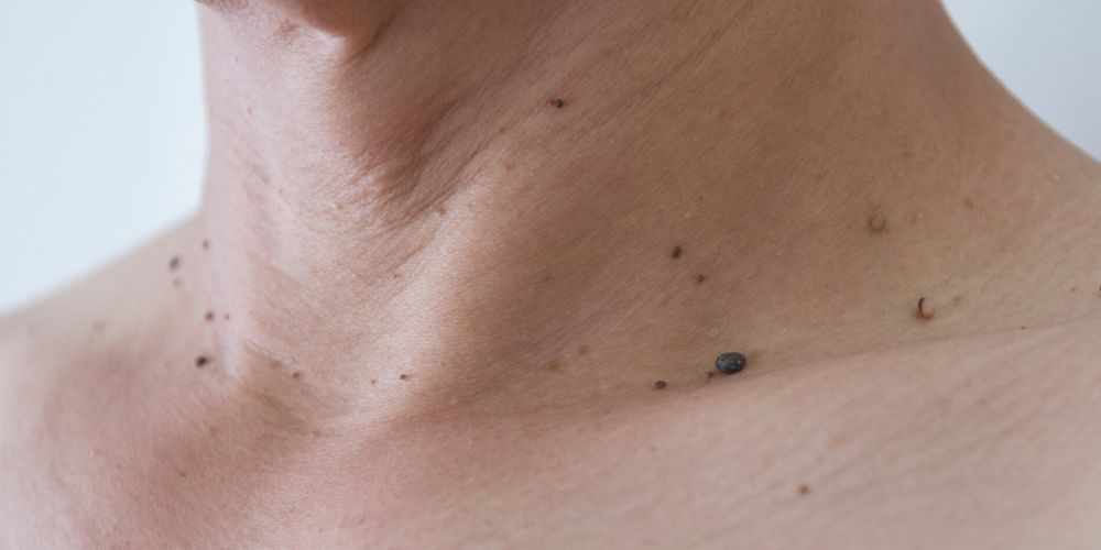 Skin Tags Body