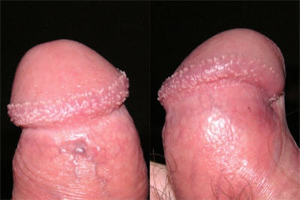 Pearly Papules