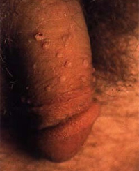 penile warts men