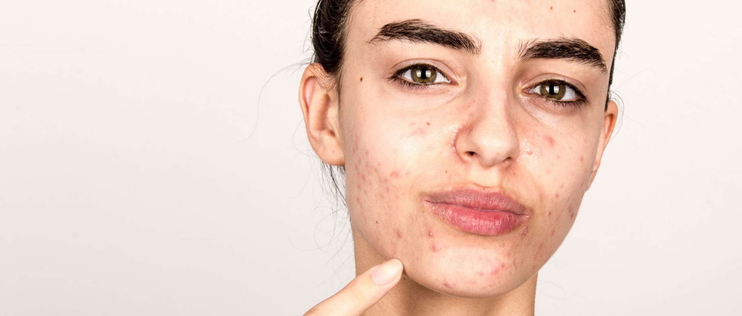 Acne Scarring