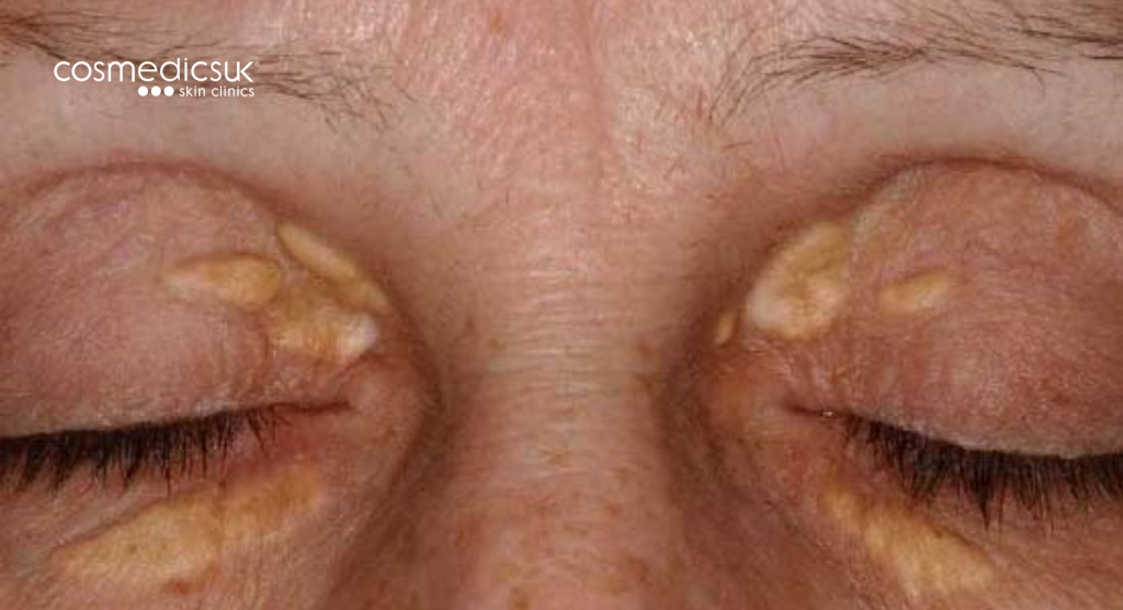 xanthelasma prior to surgery