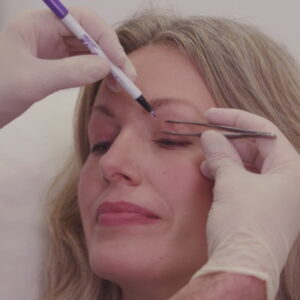 Upper blepharoplasty London