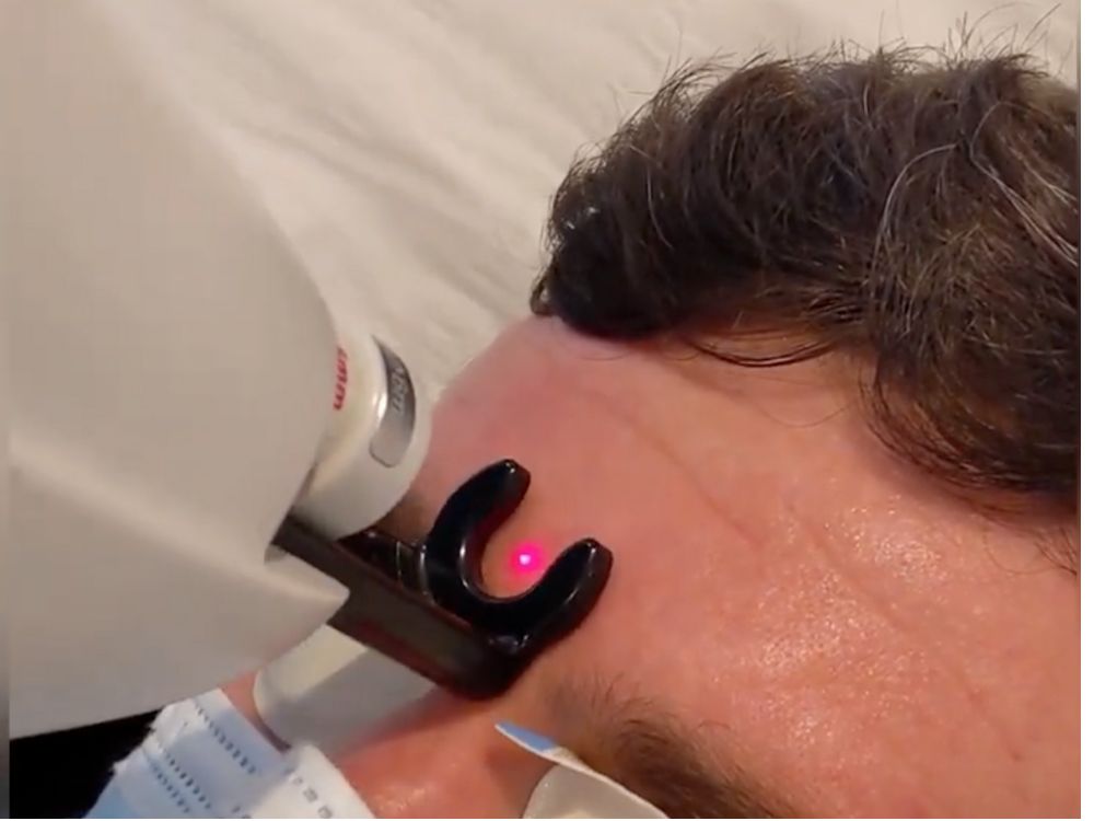 Laser Cherry Angioma Treatment