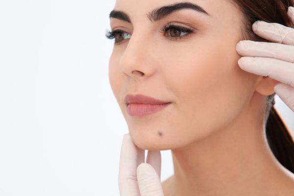 Facial Mole removal