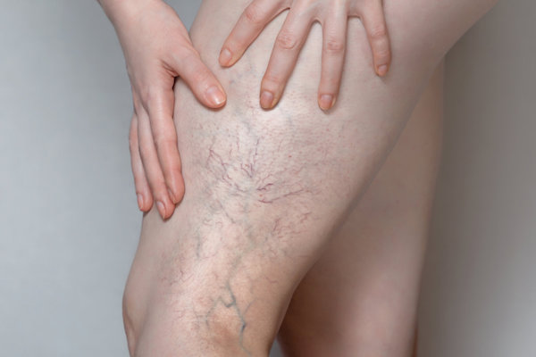 Leg Thread Vein Removal